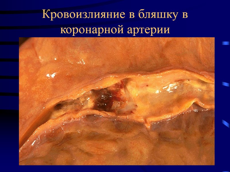 Кровоизлияние в бляшку в коронарной артерии